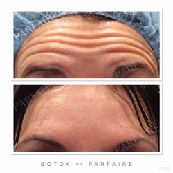 Botox Injections by Parfaire