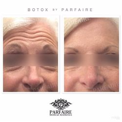 Botox Treatment By Parfaire