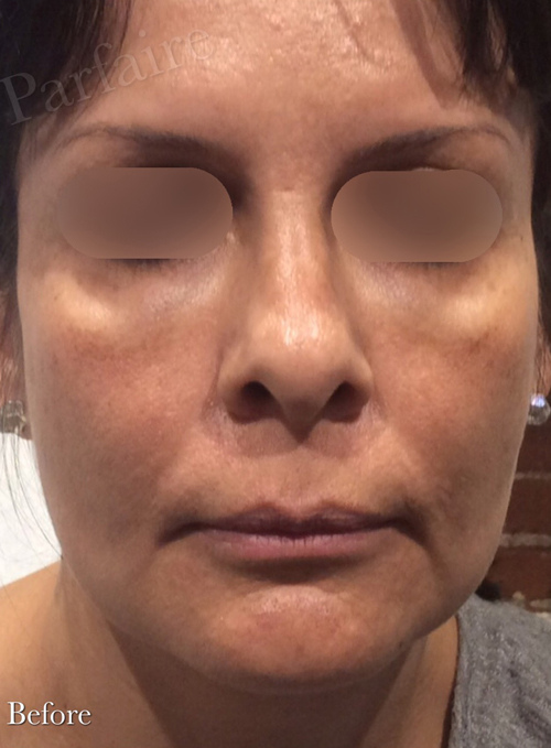 Hyaluronidase Before
