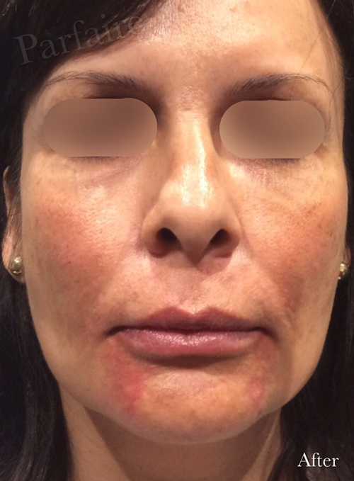 Hyaluronidase After