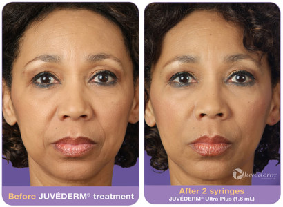 Juvederm Treatment in Pasadena
