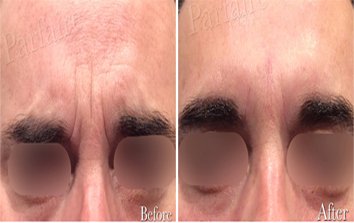 Botox