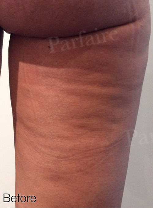 Cellulite Reduction Before
