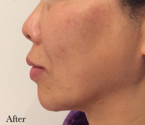 Chin Augmentation After