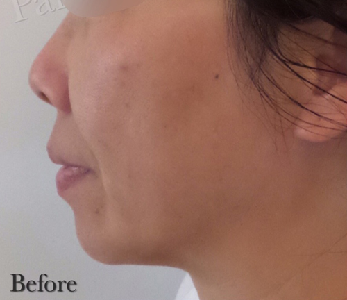 Chin Augmentation Before
