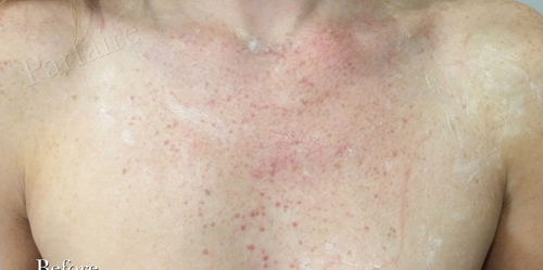 clear_03 Sunspots on Chest Before