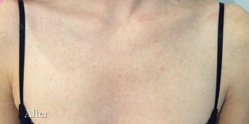 clear_06 Sunspots on Chest After