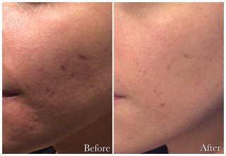 Acne Scar Correction