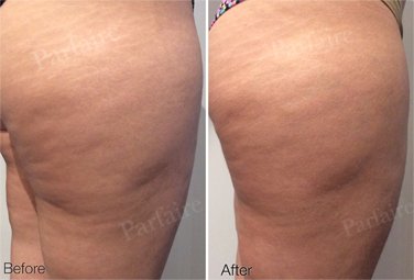 Cellulite Reduction