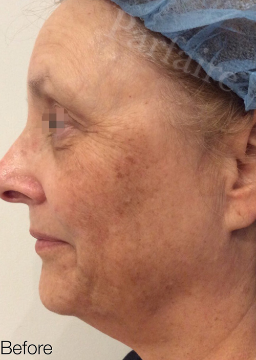 Total Skin Tightening
