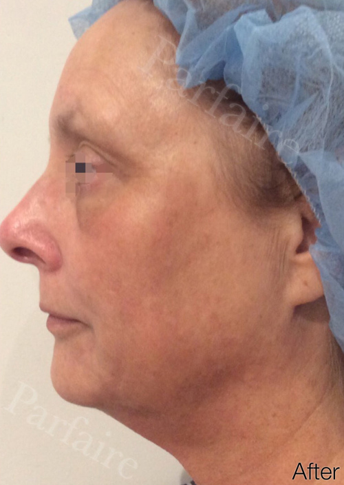Skin Tightening Treatment 2