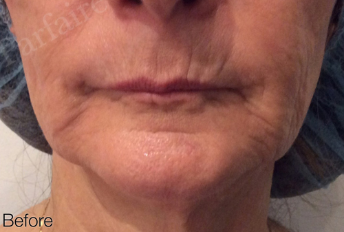 Skin Tightening Treatment 3