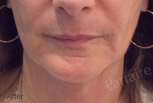 Skin Tightening Treatment 4