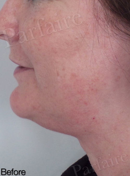 Skin Tightening Treatment 5