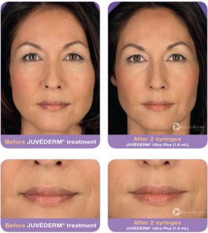 Juvederm Treatment Before After