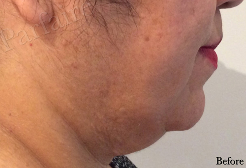 Double Chin Reduction Kybella Before