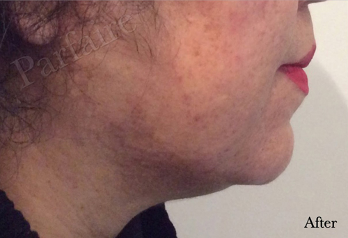 Double Chin Reduction Kybella After