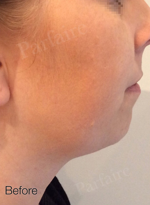 Double Chin Reduction Before