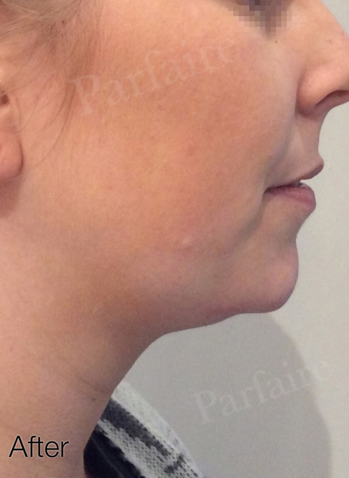 Double Chin Reduction After