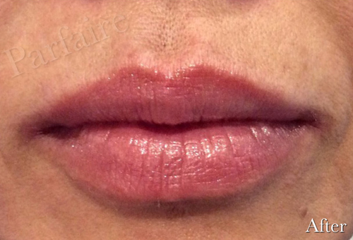Lip Augmentation After Pasadena