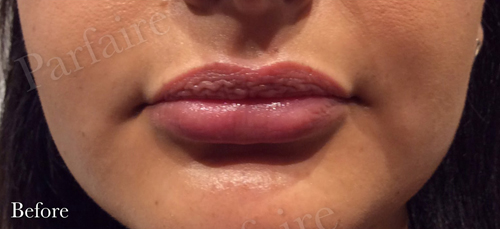 Lip Augmentation Before