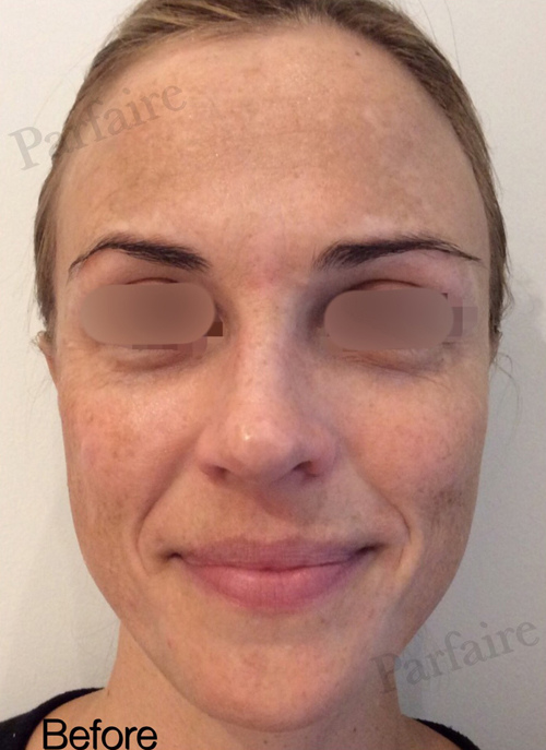 Liquid Facelift Before