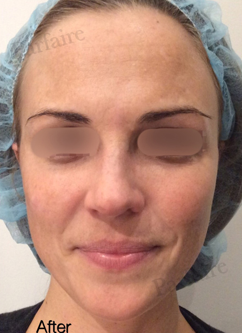 Liquid Facelift After