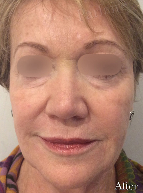 Liquid Facelift After