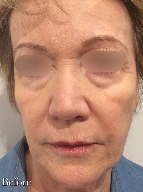 Liquid Facelift Before