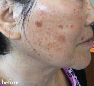 lumecca_bxa_1_01 Clear Skin Before