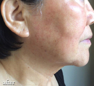 lumecca_bxa_1_02 Clear Skin After