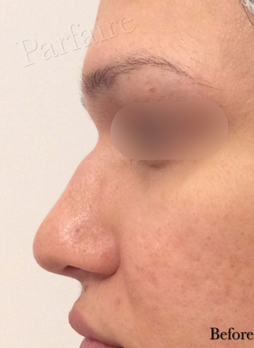 nonsurgical-rhino_06 Non Surgical Rhinoplasty Before