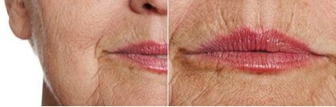 Smokers Lines Treatment by Parfaire