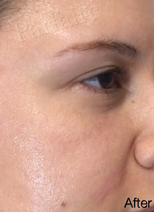 Under Eye Filler After
