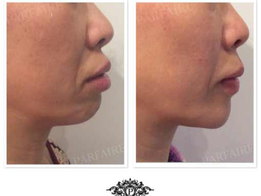 Chin Augmentation