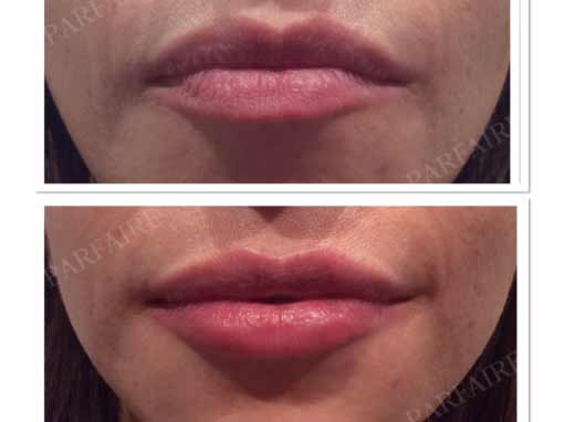 Before & After