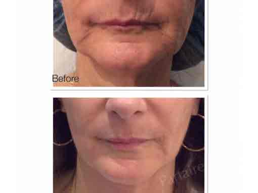 Before & After
