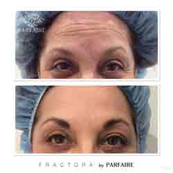 Parfaire Perfection Program