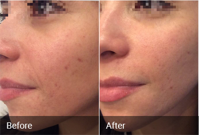 Acne Scar Treatment Before & After 4