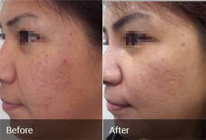 Acne Scar Treatment Before & After 2