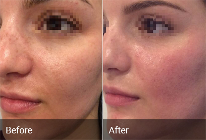 Acne Scar Treatment Before & After 3