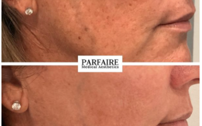 Message from parfaire: Get Clear Skin – in Just 20 Minutes