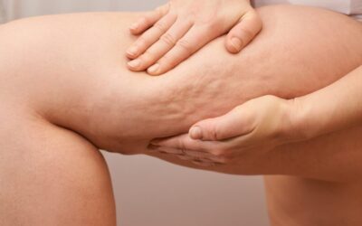 QWO for Cellulite: Your Questions Answered