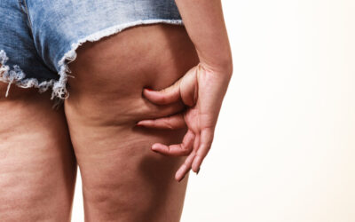 A message from Parfaire: The Newer and Longer-Lasting Cellulite Treatment – QWO