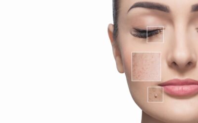 A message from Parfaire: The Goldilocks Solution to Dark Spots on Your Skin
