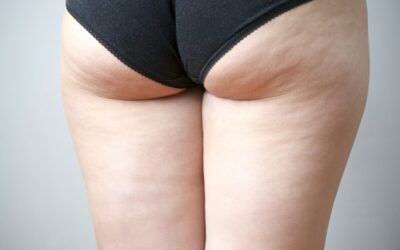 Transforming Cellulite Treatment: Liza’s Qwo Journey