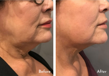 Parfaire’s PDO Thread Lift Before and After Parfaire’s PDO Thread Lift Before and After