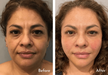 Parfaire’s PDO Thread Lift Before and After Parfaire’s PDO Thread Lift Before and After