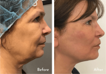 Parfaire’s PDO Thread Lift Before and After Parfaire’s PDO Thread Lift Before and After