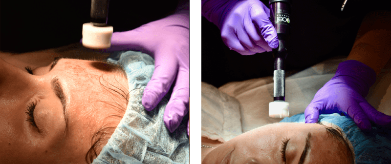 long_treatment_micro